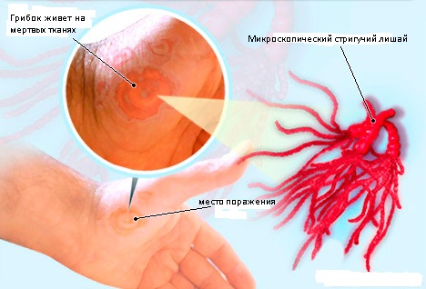 Стригущий лишай